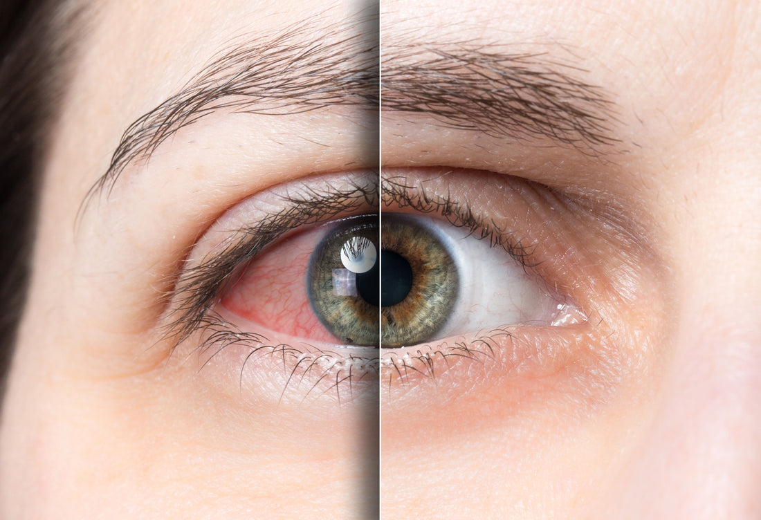 Game Changing Dry Eye Treatment - Optima IPL